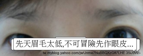Dissatisfied-with-double-eyelid-surgery-05