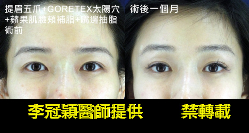 Dissatisfied-with-double-eyelid-surgery-09