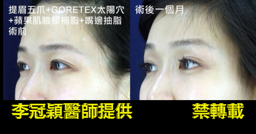 Dissatisfied-with-double-eyelid-surgery-10