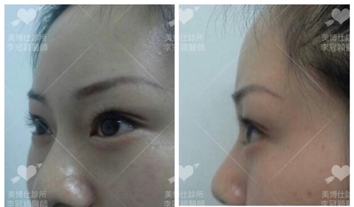 Dissatisfied-with-double-eyelid-surgery-11