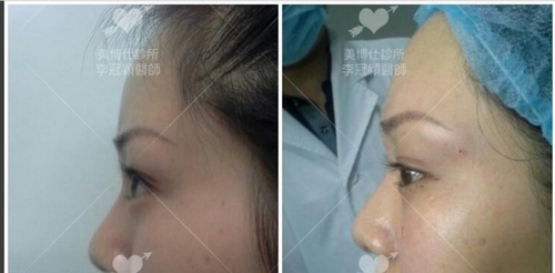 Dissatisfied-with-double-eyelid-surgery-13