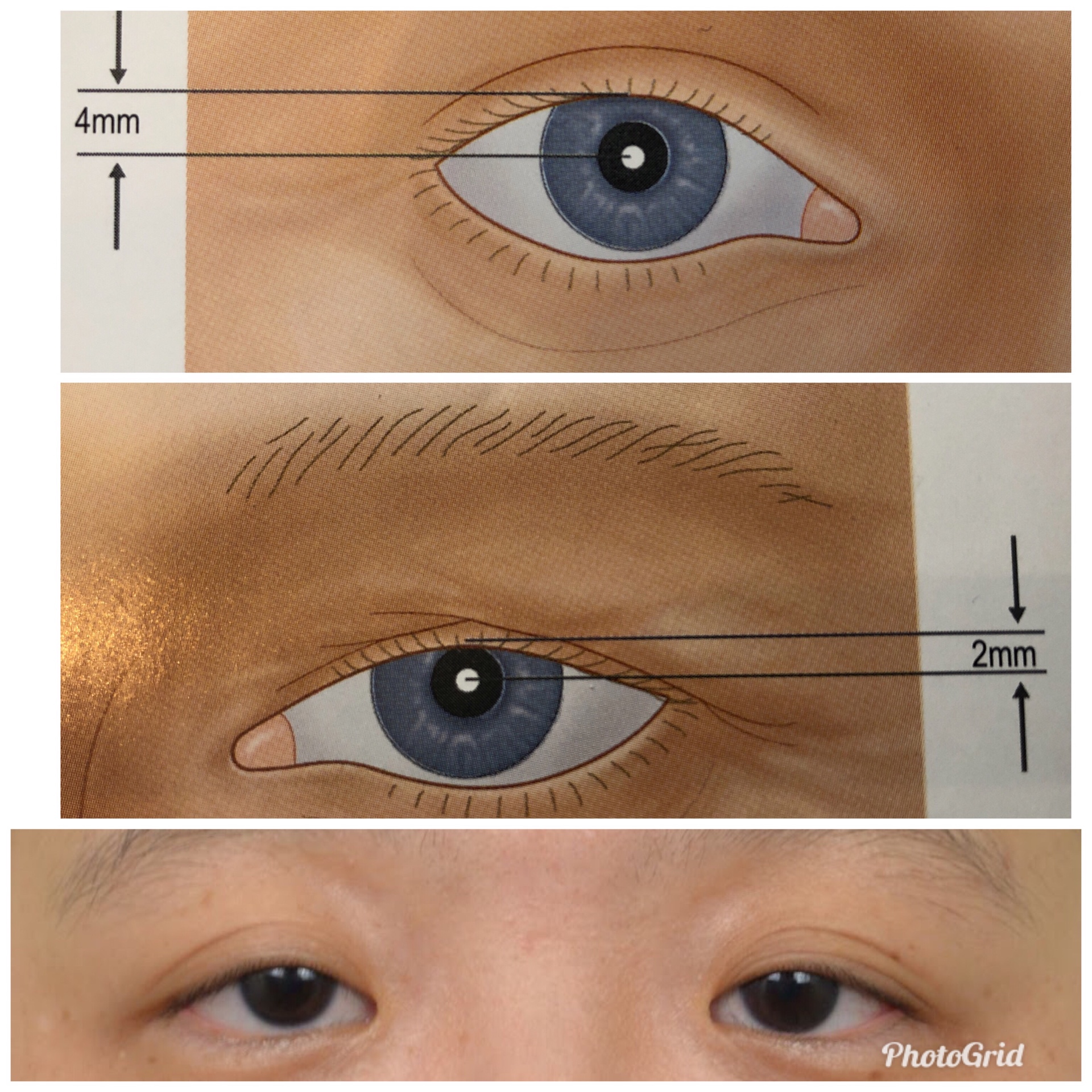 提眼瞼肌無力治療-台中整形外科診所
