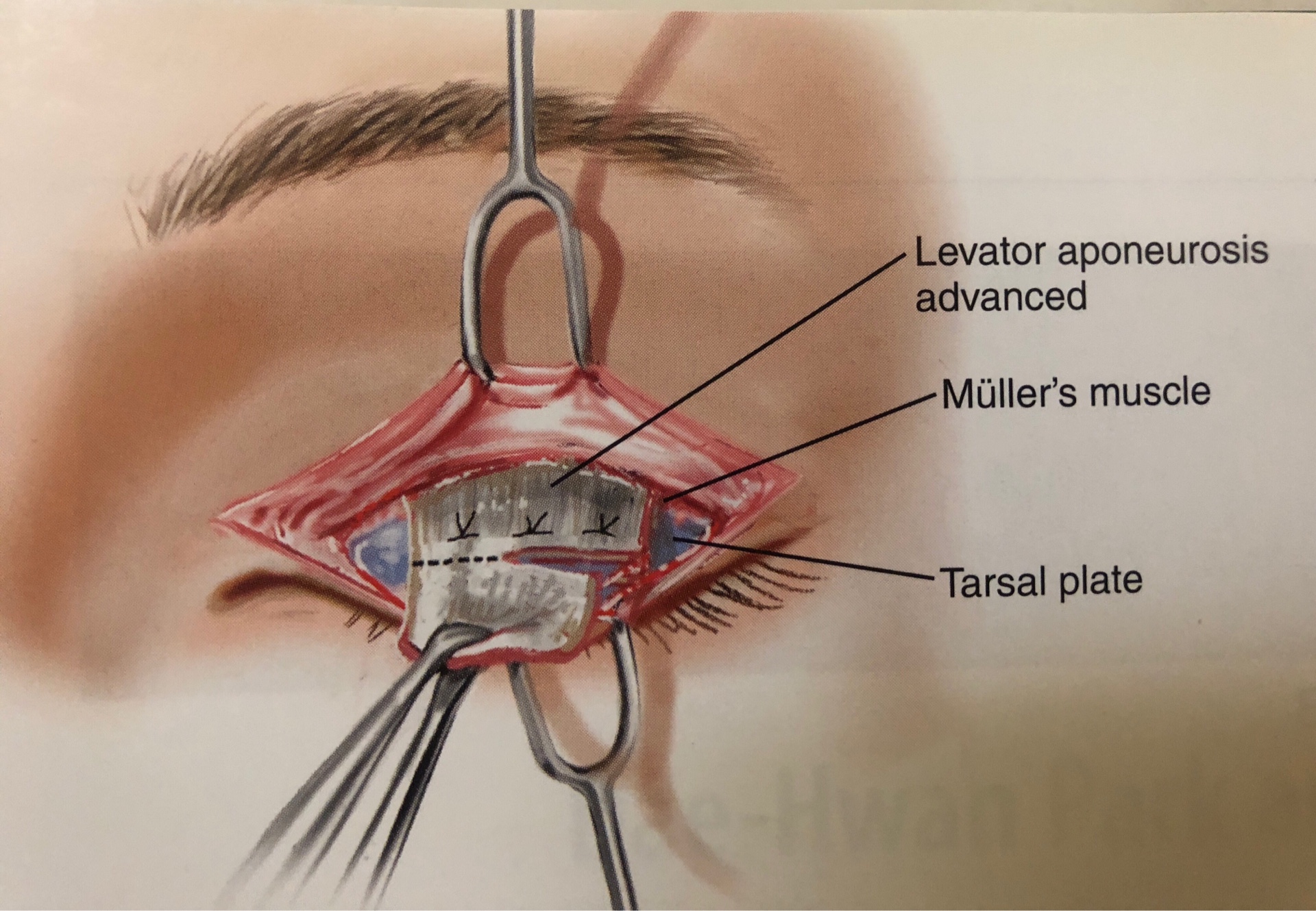 myasthenia-gravis-5-提眼瞼肌無力手術治療-台中整形外科診所